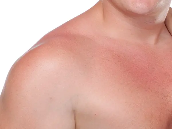 sunburn skin closeup
